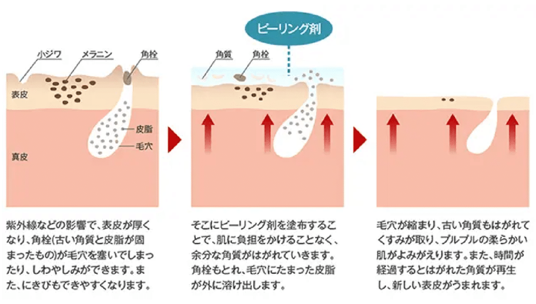 サリチル酸マクロゴールピーリング